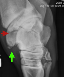 Osteochondritis Dissecans (OCD)