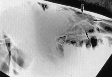 Progressive Ethmoid Hematoma